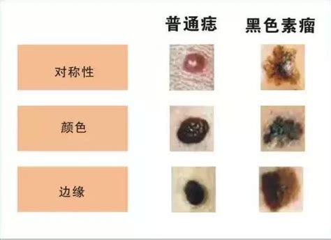 陰莖長痣|陰莖上的痣：該看皮膚科還是泌尿科？手術後恢復期大約多久？